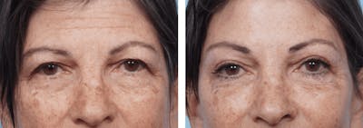 Dr. Balikian's Blepharoplasty Before & After Gallery - Patient 2167783 - Image 1