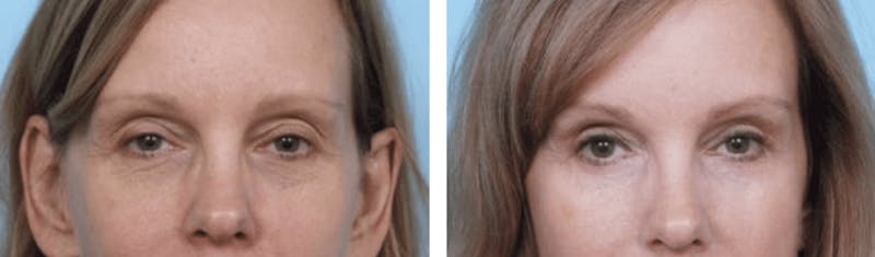 Dr. Balikian's Blepharoplasty Before & After Gallery - Patient 2167789 - Image 1