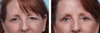 Dr. Balikian's Blepharoplasty Before & After Gallery - Patient 2167791 - Image 1