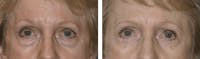 Dr. Balikian's Blepharoplasty Before & After Gallery - Patient 2167793 - Image 1