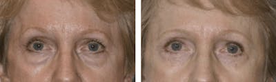 Dr. Balikian's Blepharoplasty Before & After Gallery - Patient 2167793 - Image 1