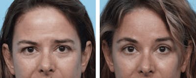 Dr. Balikian's Blepharoplasty Before & After Gallery - Patient 2167797 - Image 1