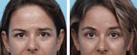 Dr. Balikian's Blepharoplasty Before & After Gallery - Patient 2167797 - Image 1
