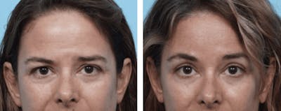Dr. Balikian's Blepharoplasty Gallery - Patient 2167797 - Image 1