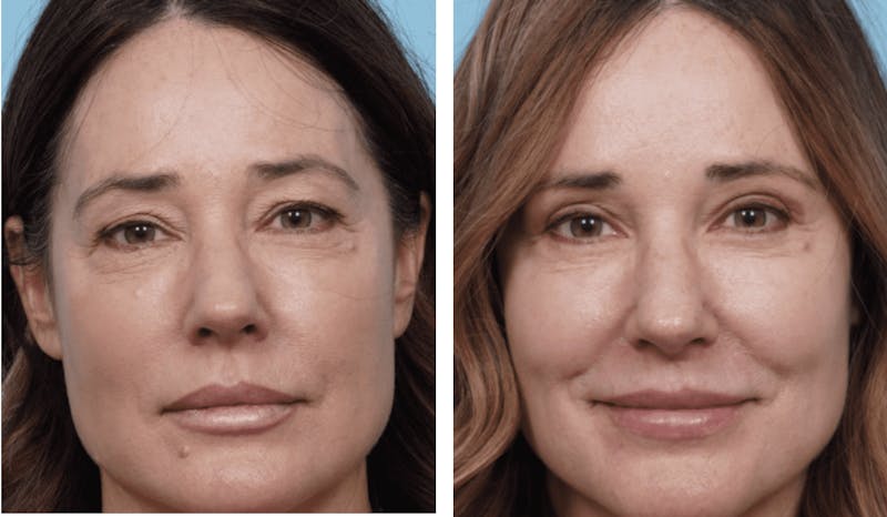 Dr. Balikian's Blepharoplasty Gallery - Patient 2167799 - Image 1