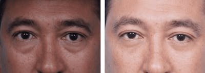 Dr. Balikian's Blepharoplasty Before & After Gallery - Patient 2167802 - Image 1