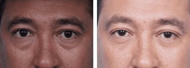 Dr. Balikian's Blepharoplasty Gallery - Patient 2167802 - Image 1