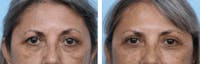 Dr. Balikian's Blepharoplasty Before & After Gallery - Patient 2167804 - Image 1