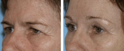 Dr. Balikian's Blepharoplasty Before & After Gallery - Patient 2167806 - Image 1