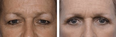 Dr. Balikian's Blepharoplasty Before & After Gallery - Patient 2167808 - Image 1