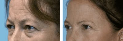 Dr. Balikian's Blepharoplasty Before & After Gallery - Patient 2167810 - Image 1