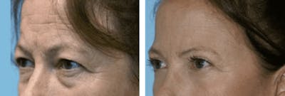 Dr. Balikian's Blepharoplasty Before & After Gallery - Patient 2167810 - Image 1