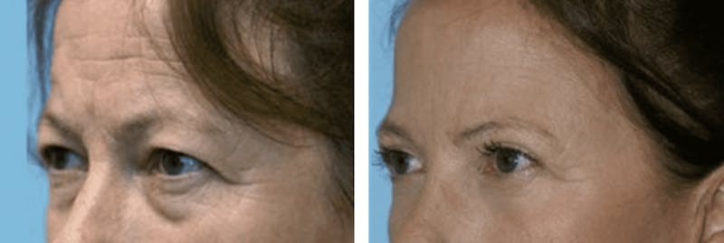 Dr. Balikian's Blepharoplasty Before & After Gallery - Patient 2167810 - Image 1