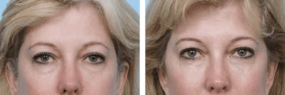 Dr. Balikian's Blepharoplasty Before & After Gallery - Patient 2167812 - Image 1