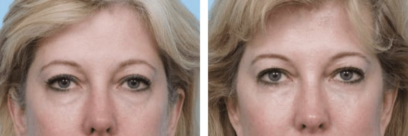 Dr. Balikian's Blepharoplasty Before & After Gallery - Patient 2167812 - Image 1
