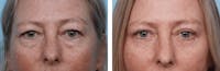 Dr. Balikian's Blepharoplasty Before & After Gallery - Patient 2167824 - Image 1