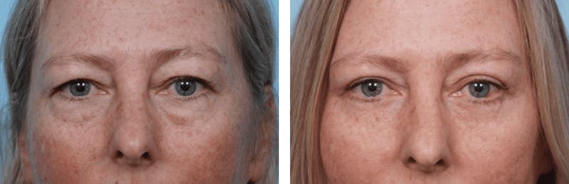 Dr. Balikian's Blepharoplasty Before & After Gallery - Patient 2167824 - Image 1
