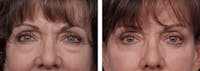 Dr. Balikian's Blepharoplasty Before & After Gallery - Patient 2167826 - Image 1