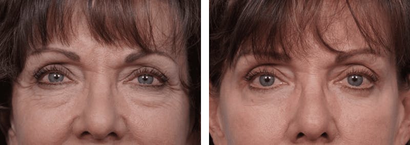 Dr. Balikian's Blepharoplasty Before & After Gallery - Patient 2167826 - Image 1