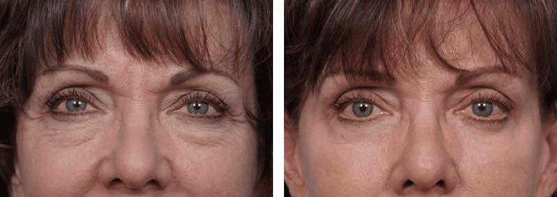 Dr. Balikian's Blepharoplasty Gallery - Patient 2167826 - Image 1
