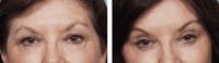 Dr. Balikian's Blepharoplasty Gallery - Patient 2167829 - Image 1