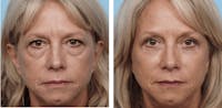 Dr. Balikian's Blepharoplasty Before & After Gallery - Patient 2167831 - Image 1