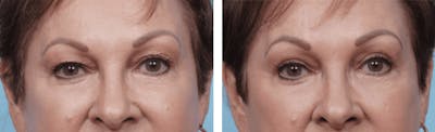 Dr. Balikian's Blepharoplasty Before & After Gallery - Patient 2167833 - Image 1