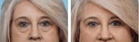 Dr. Balikian's Blepharoplasty Before & After Gallery - Patient 2167835 - Image 1
