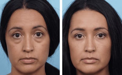 Dr. Balikian's Blepharoplasty Before & After Gallery - Patient 2167837 - Image 1