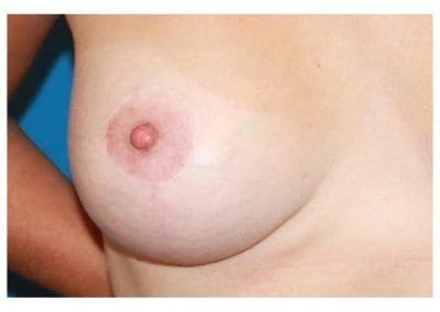 Breast Lift Before & After Gallery - Patient 2237970 - Image 1