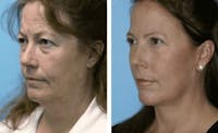 Dr. Balikian's Facelift Before & After Gallery - Patient 2167292 - Image 1