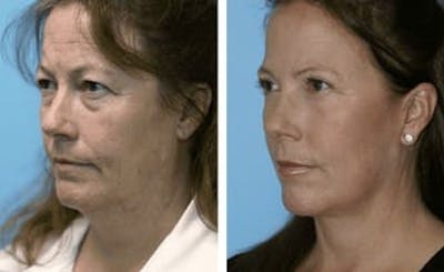 Dr. Balikian's Facelift Before & After Gallery - Patient 2167292 - Image 1