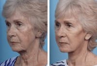 Dr. Balikian's Facelift Before & After Gallery - Patient 2167298 - Image 1