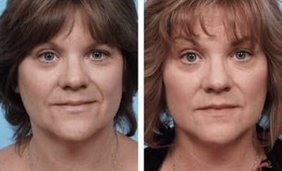 Dr. Balikian's Facelift Before & After Gallery - Patient 2167322 - Image 1
