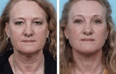 Dr. Balikian's Facelift Before & After Gallery - Patient 2167327 - Image 1