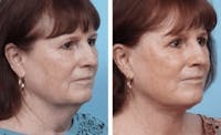 Dr. Balikian's Facelift Before & After Gallery - Patient 2167346 - Image 1