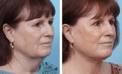Dr. Balikian's Facelift Before & After Gallery - Patient 2167346 - Image 1