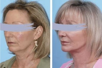 Dr. Balikian's Facelift Before & After Gallery - Patient 2167377 - Image 1
