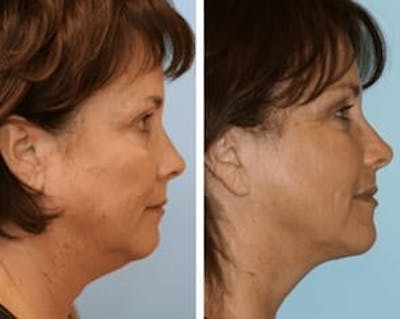 Dr. Balikian's Facelift Before & After Gallery - Patient 2167389 - Image 1