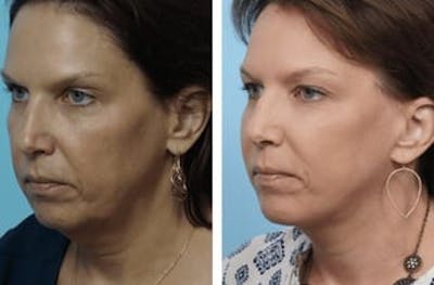 Dr. Balikian's Facelift Before & After Gallery - Patient 2167397 - Image 1