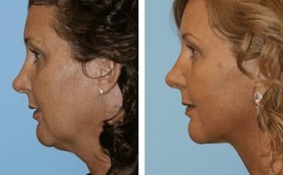 Dr. Balikian's Facelift Before & After Gallery - Patient 2167399 - Image 1