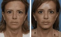 Dr. Balikian's Facelift Before & After Gallery - Patient 2167401 - Image 1