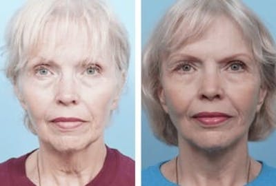 Dr. Balikian's Facelift Before & After Gallery - Patient 2167430 - Image 1