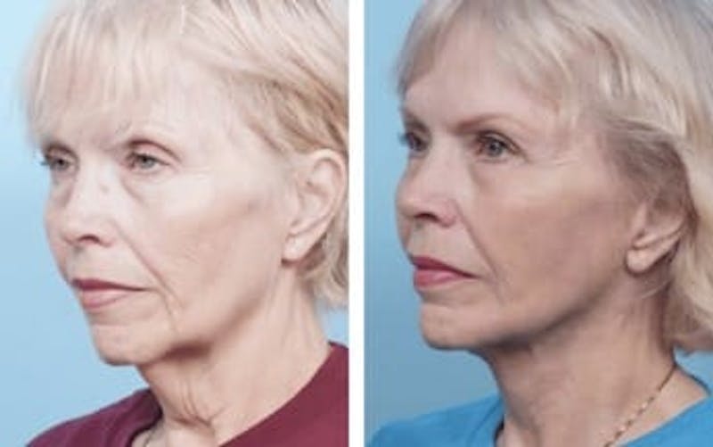 Dr. Balikian's Facelift Gallery - Patient 2167430 - Image 2