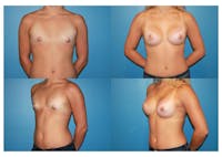 Large B Cup Augmentation Before & After Gallery - Patient 2396612 - Image 1