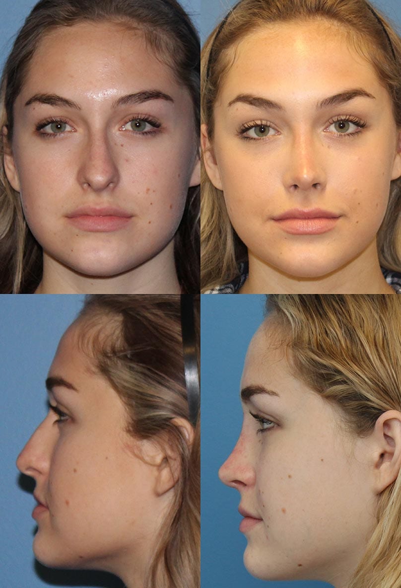 Before and after Rhinoplasty.