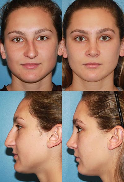 Crooked Nose Before & After Gallery - Patient 363092 - Image 1