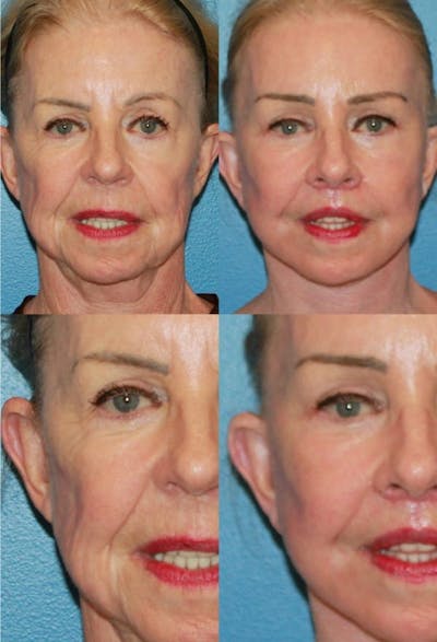 Brow Lift Before & After Gallery - Patient 2848099 - Image 1