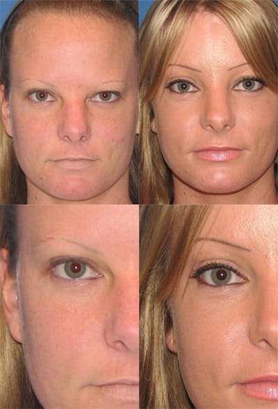 Brow Lift Before & After Gallery - Patient 2848100 - Image 1