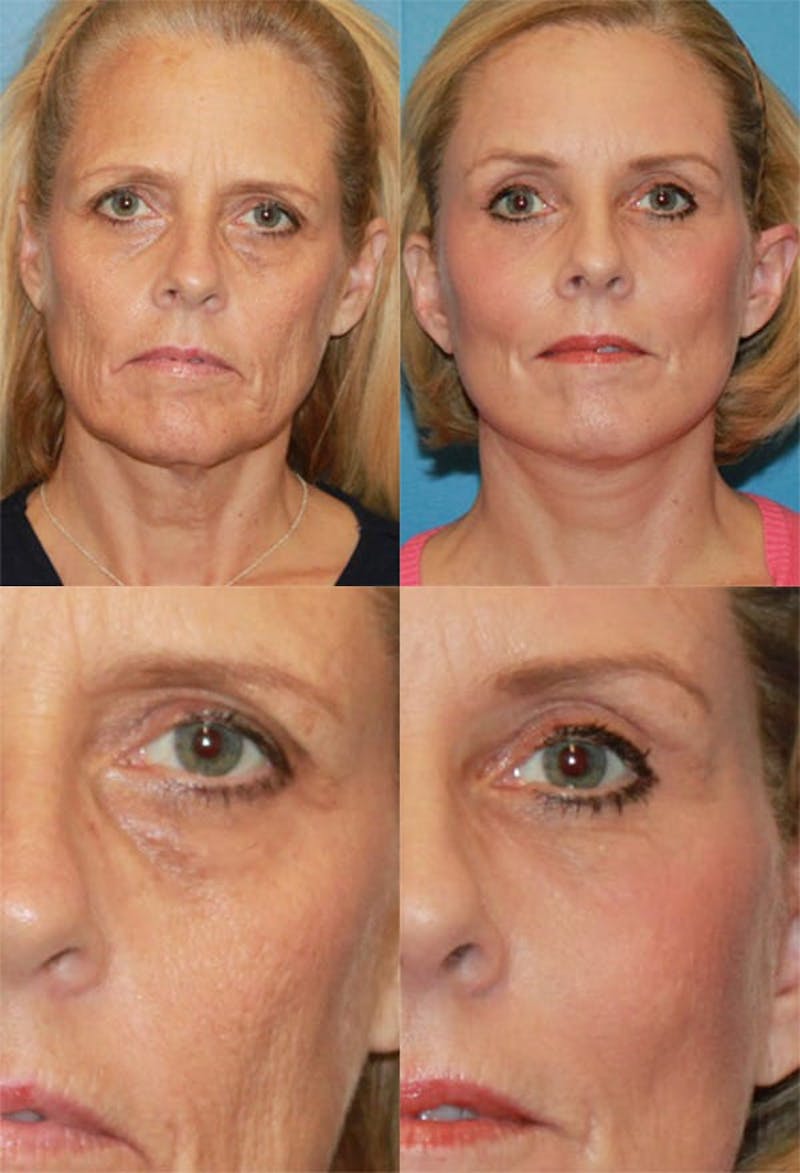 Brow Lift Before & After Gallery - Patient 2848101 - Image 1